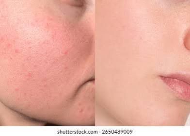 Peau Acnéique : La Routine Coréenne qui Apaise les Boutons Sans Agress­er la Peau