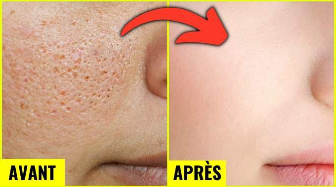 Pores Dilatés : La Routine Coréenne Pour Une Peau Plus Lisse et Un Grain de Peau Affiné