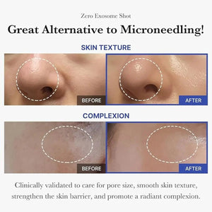medicube exosmose serum peau grasse 