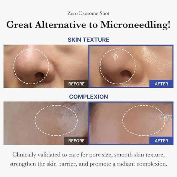 medicube exosmose serum peau grasse 